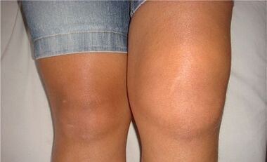 Causes of knee joint arthrosis