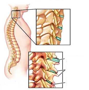 Comparison of a healthy and sick vertebra in the neck