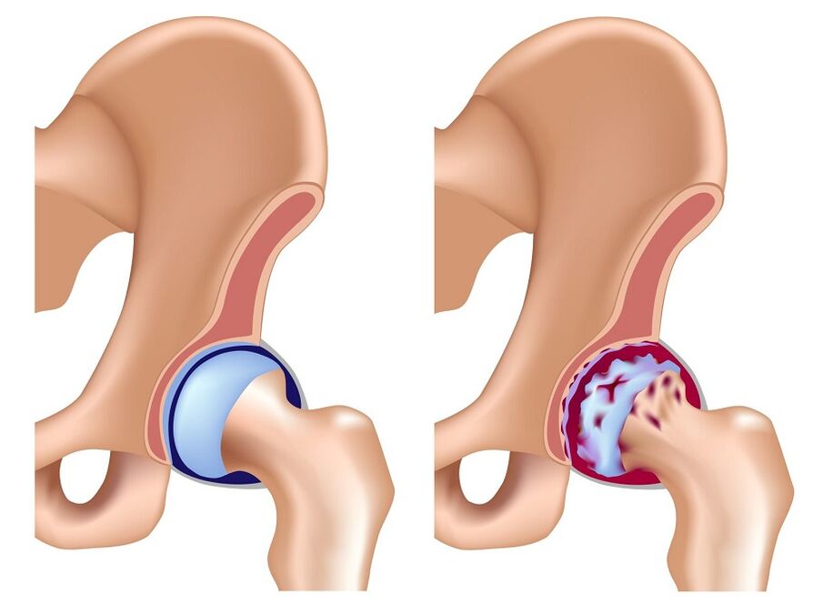 Healthy and arthritis of the hip joint